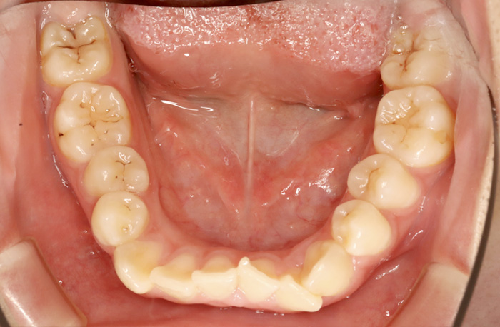 インビザラインの症例