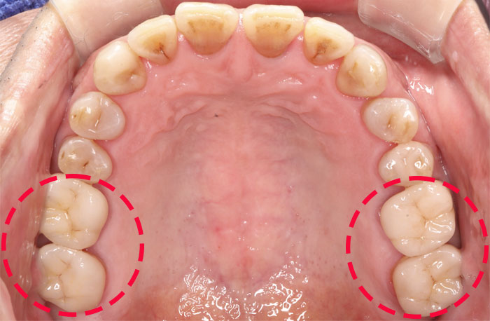 審美歯科治療後の症例