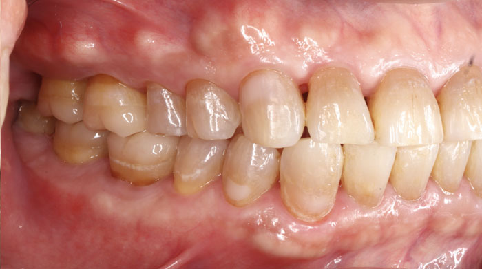 審美歯科治療前の症例