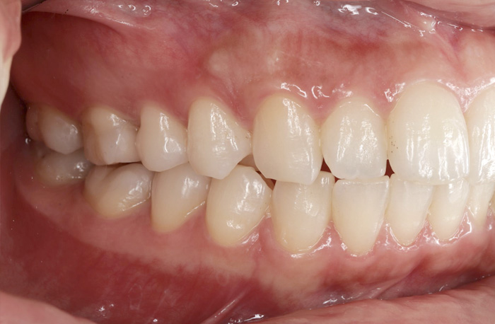 審美歯科治療後の症例