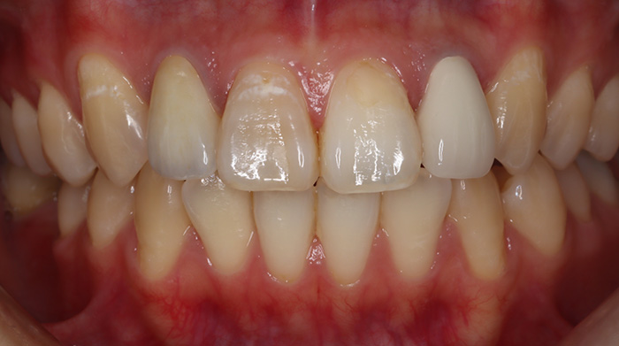 審美歯科治療後の症例