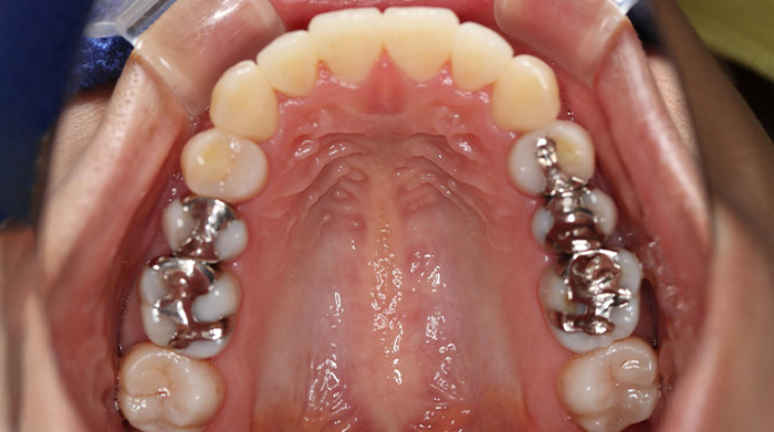 審美歯科治療前の症例