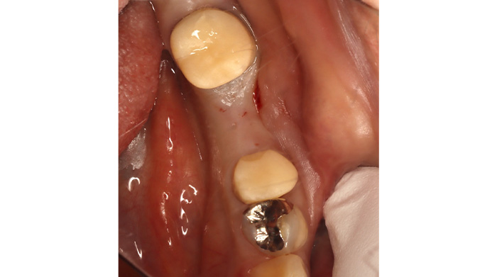 インプラントの症例