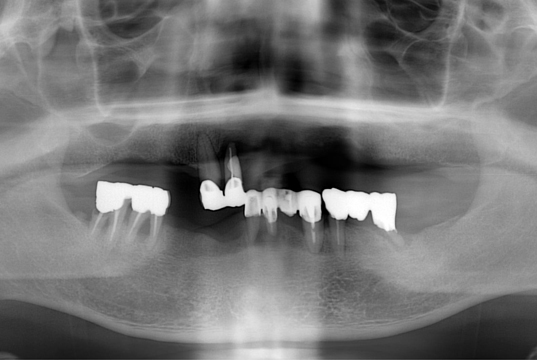 インプラントの症例