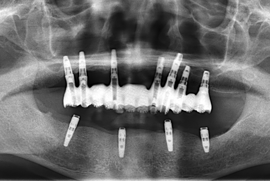 インプラントの症例