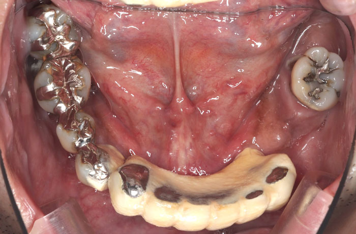 インプラントの症例