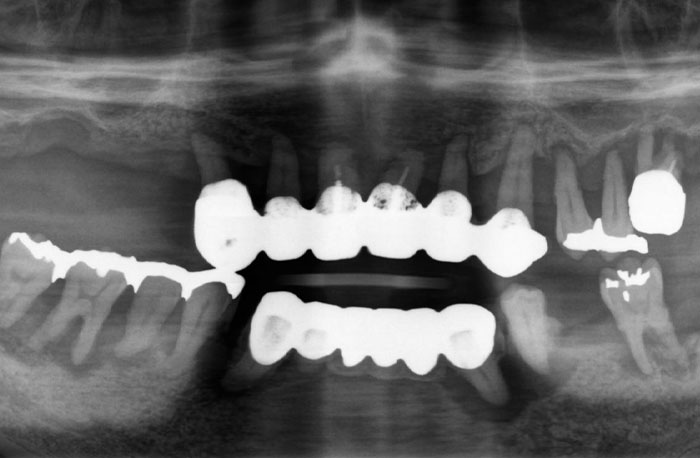 インプラントの症例