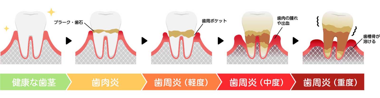 歯周病