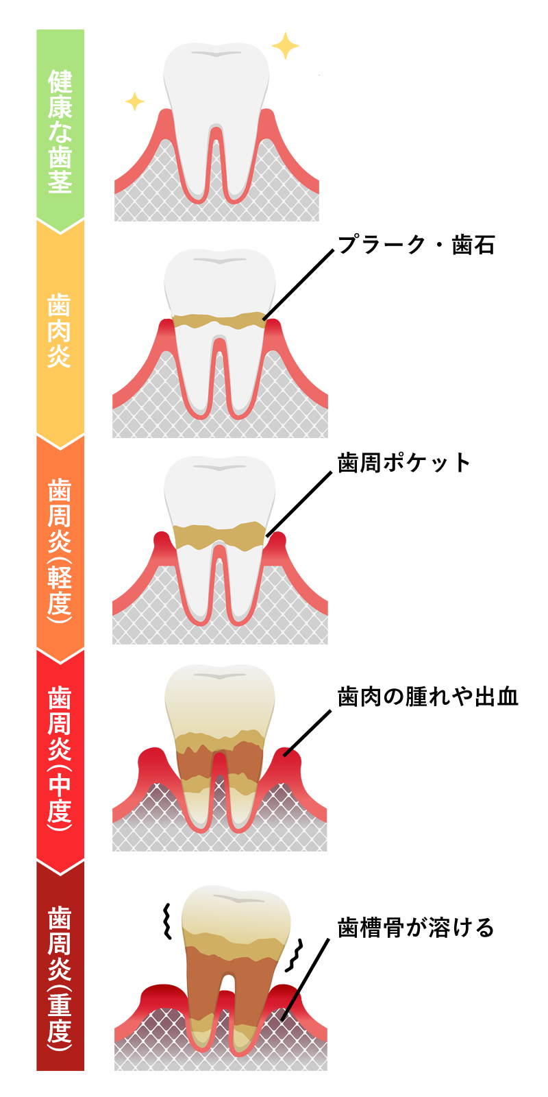 歯周病