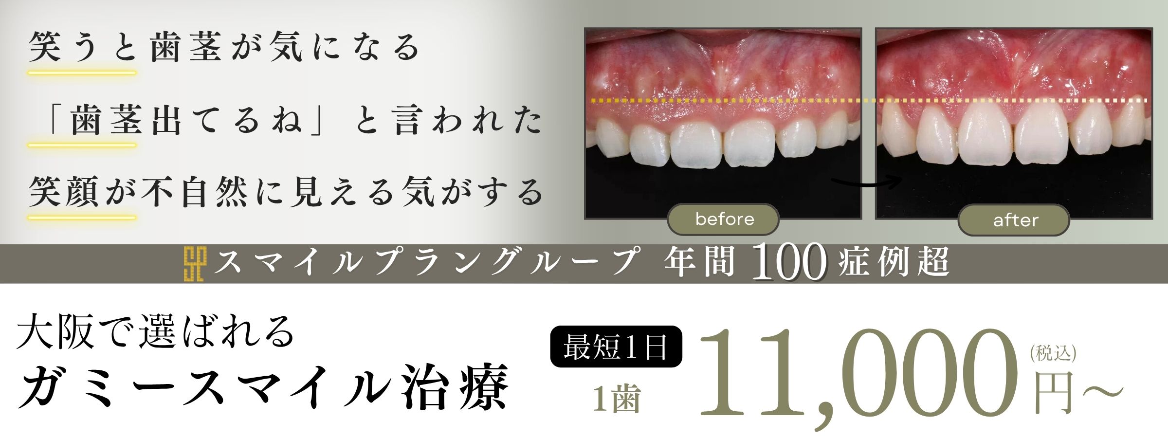 大阪・なんばのガミースマイル名医・最短1日1万円